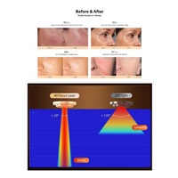 JOVS 4D laserová světelná terapeutická maska