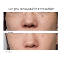 JOVS Blacken Pro DPL fotofacial přístroj na péči o pleť