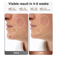 JOVS LED světelná terapeutická maska na obličej