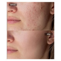 JOVS přístroj na léčbu akné Acneaway