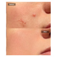 JOVS přístroj na léčbu akné Acneaway