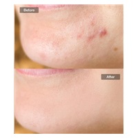 JOVS přístroj na léčbu akné Acneaway