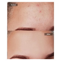 JOVS přístroj na léčbu akné Acneaway