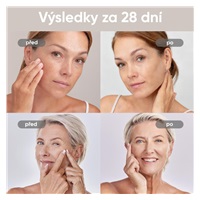 BAZAR - JOVS 4D v2 laserová světelná terapeutická maska - Poškozený obal (Komplet)